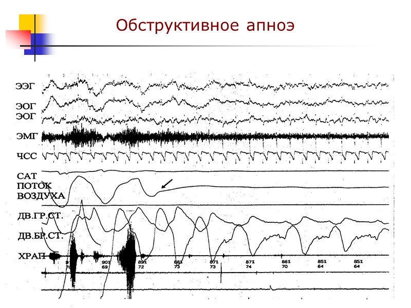 Обструктивное апноэ